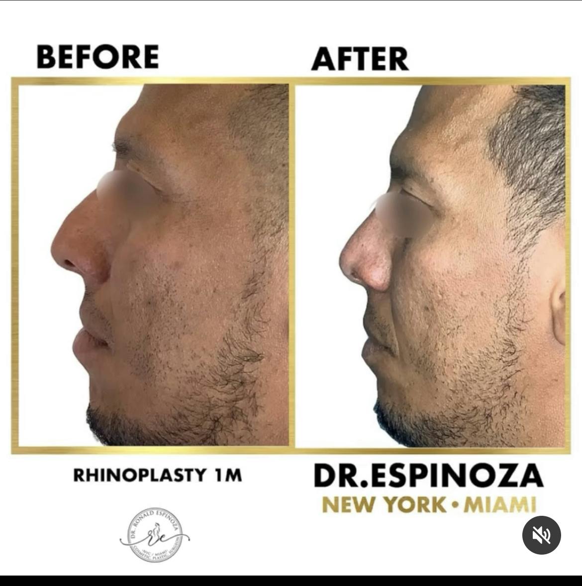 Before & After Nose Surgery by Dr. Ronald Espinoza