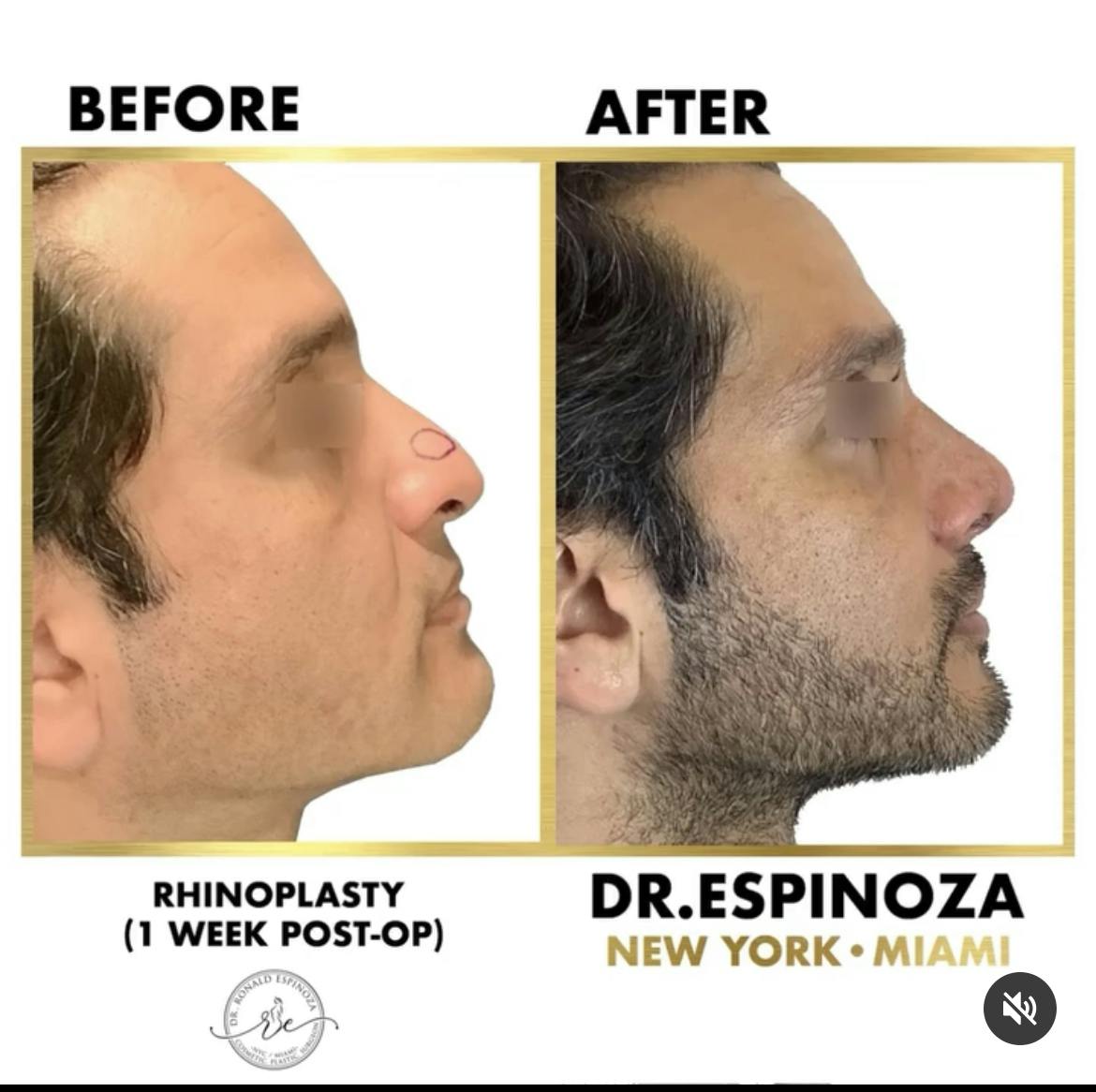 Before and After Rhinoplasty by Dr. Espinoza
