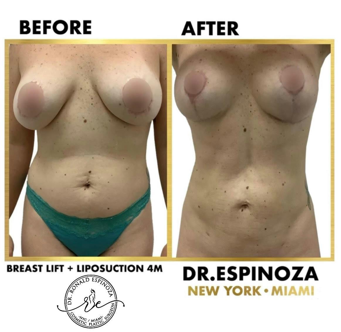 Liposuction Before & After Gallery - Patient 103282135 - Image 1