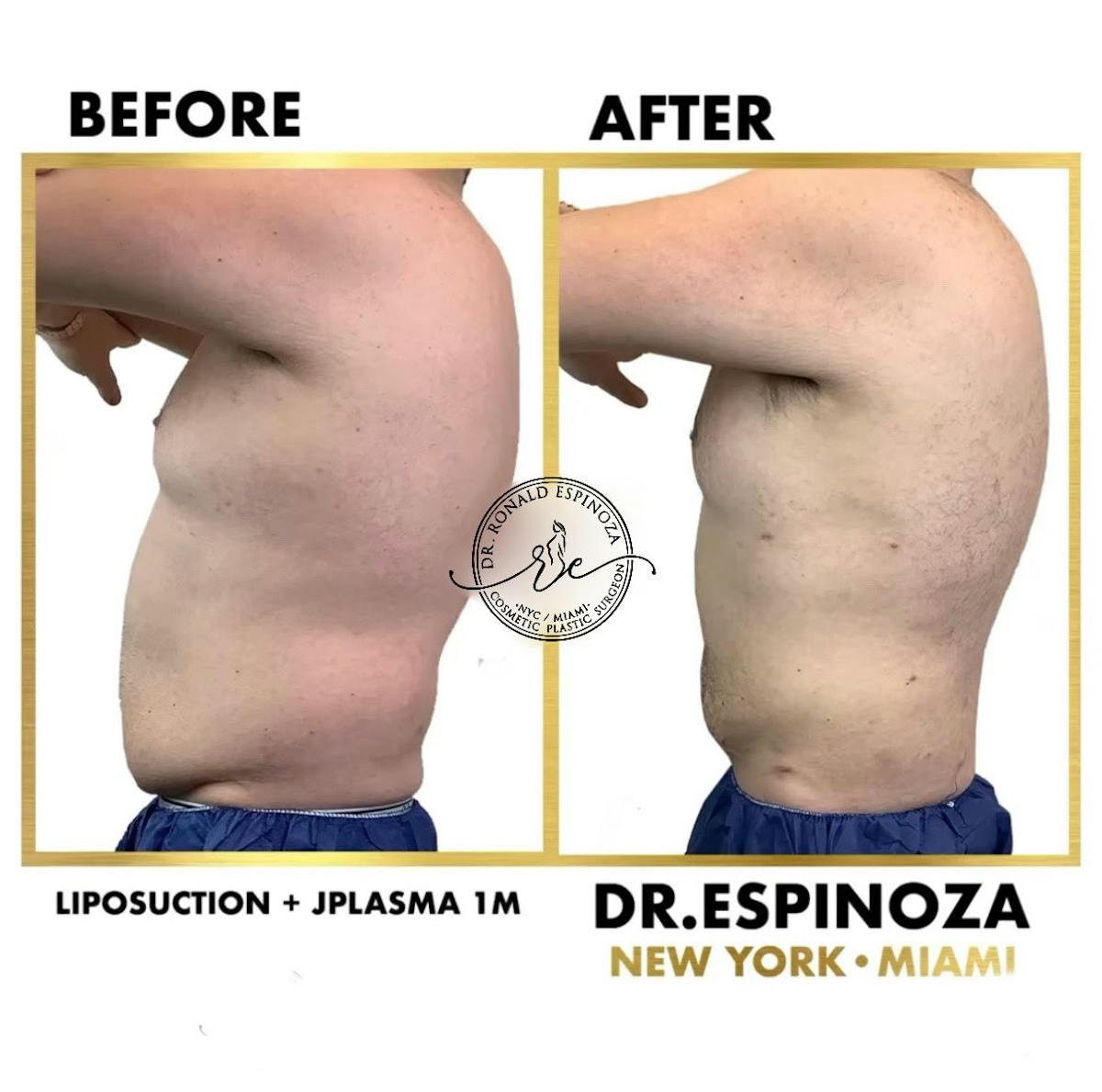 Liposuction Before & After Gallery - Patient 103282169 - Image 1