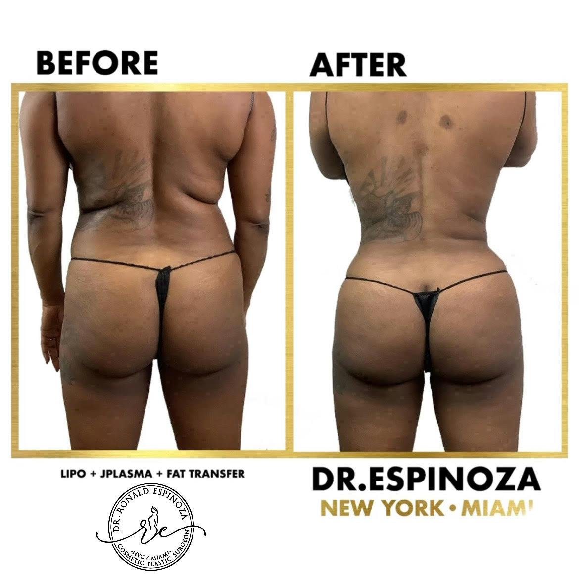 Fat Transfer Before & After Gallery - Patient 103282243 - Image 1