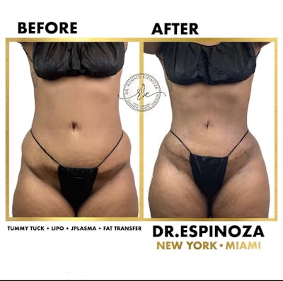 Tummy Tuck Gallery Dr Ronald Espinoza Cosmetic Plastic Surgery