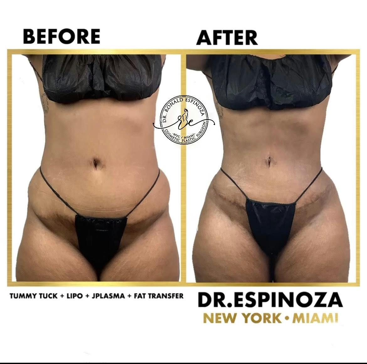 Tummy Tuck Before & After Gallery - Patient 103282257 - Image 1