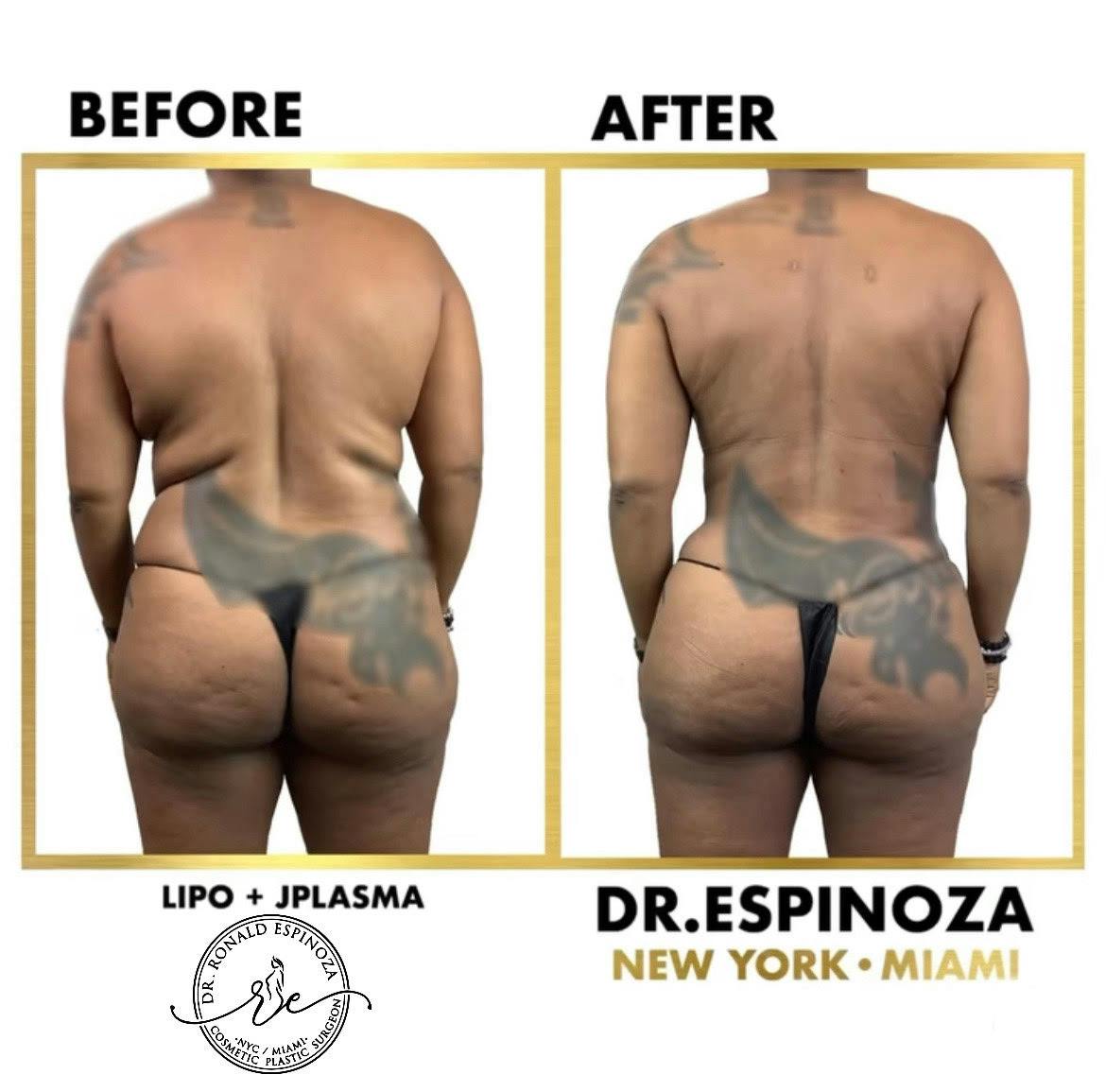 Liposuction Before & After Gallery - Patient 103282292 - Image 1