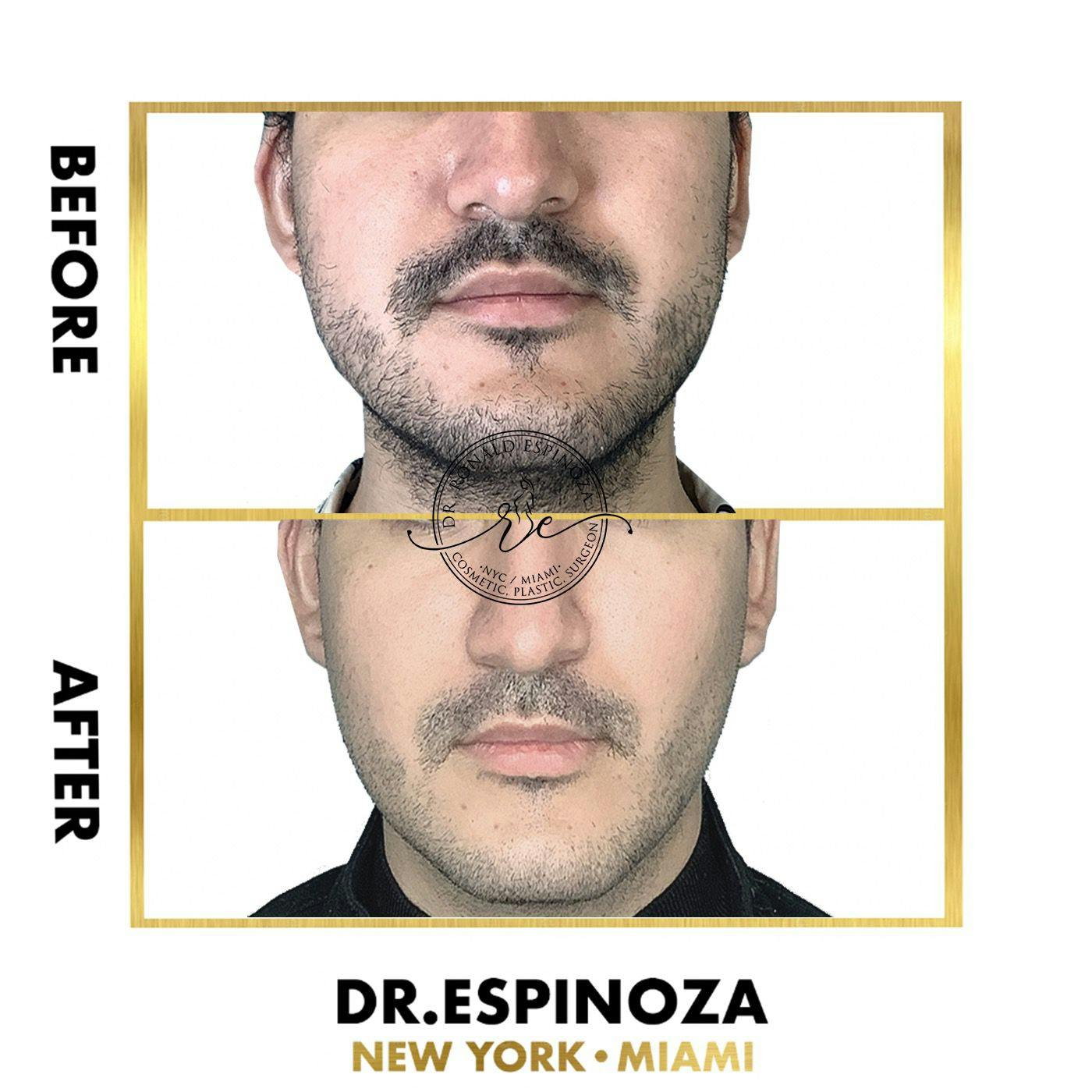 Facelift Before & After Gallery - Patient 118558414 - Image 1