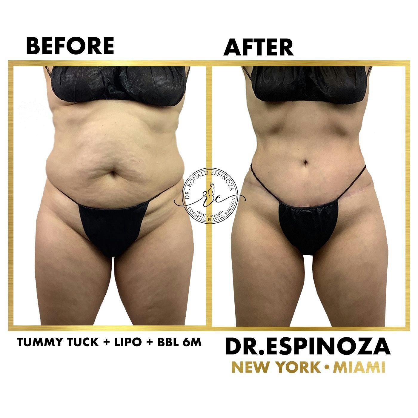 Tummy Tuck Before & After Gallery - Patient 118558430 - Image 1