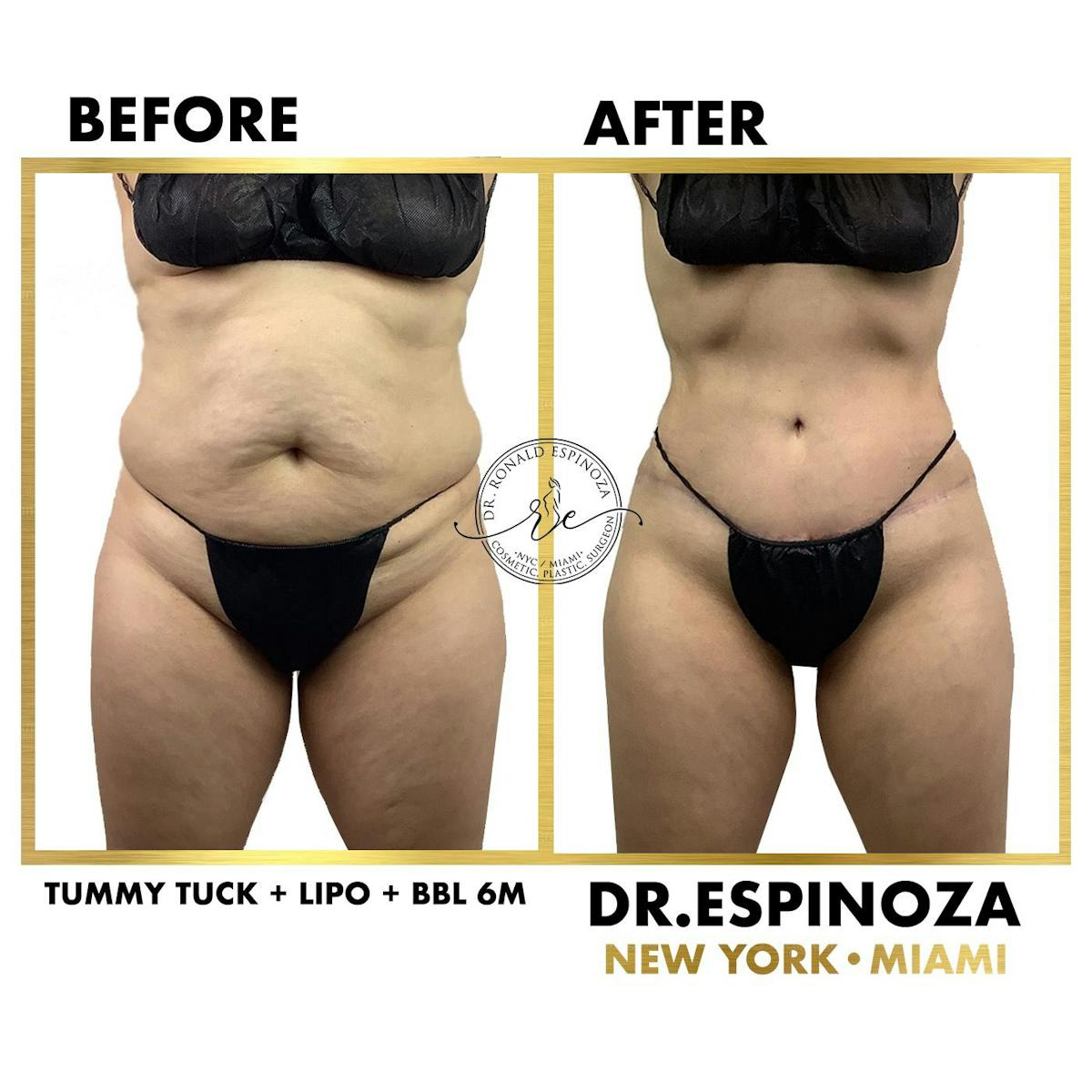 Tummy Tuck Before & After Gallery - Patient 118558430 - Image 1
