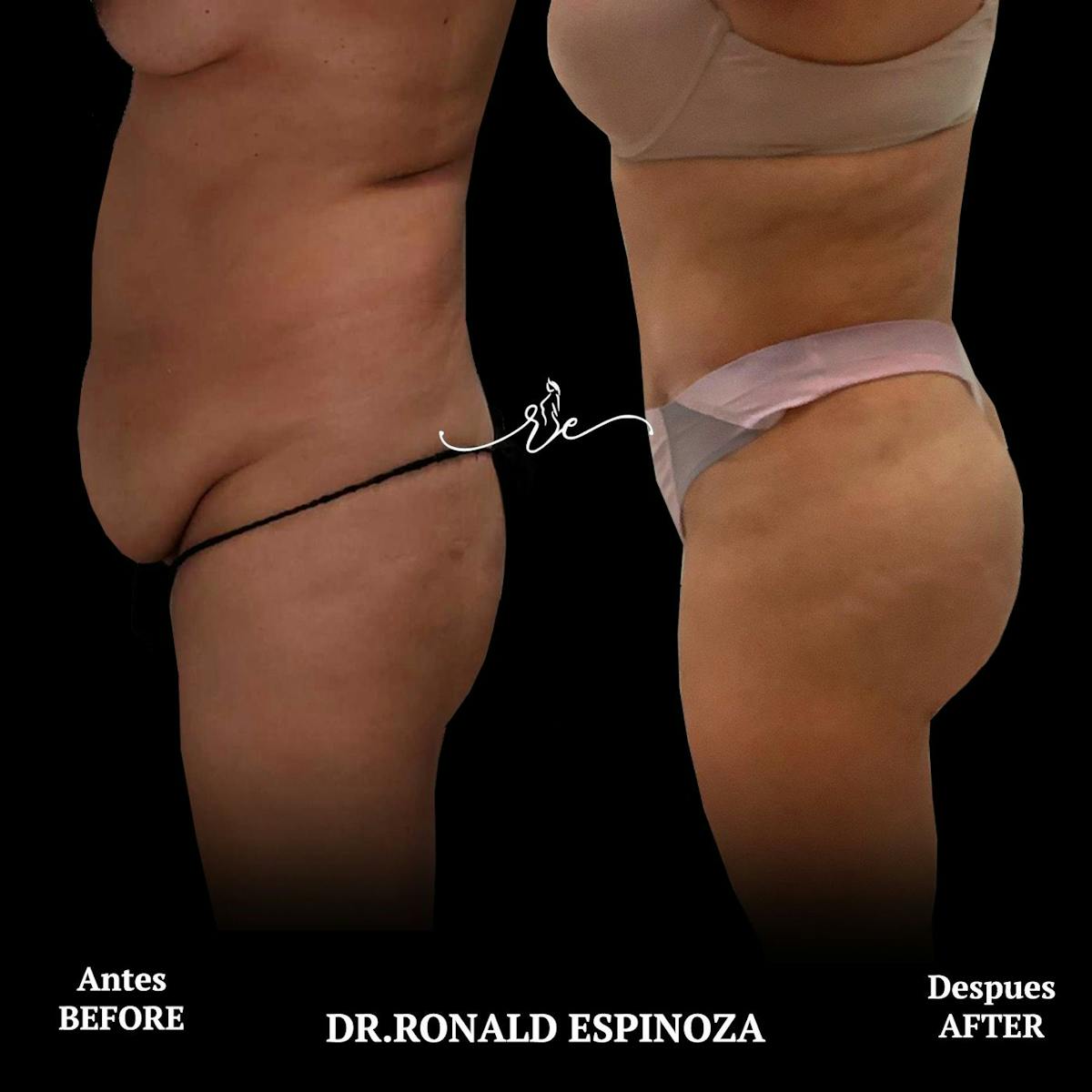 Tummy Tuck Before & After Gallery - Patient 119147146 - Image 1