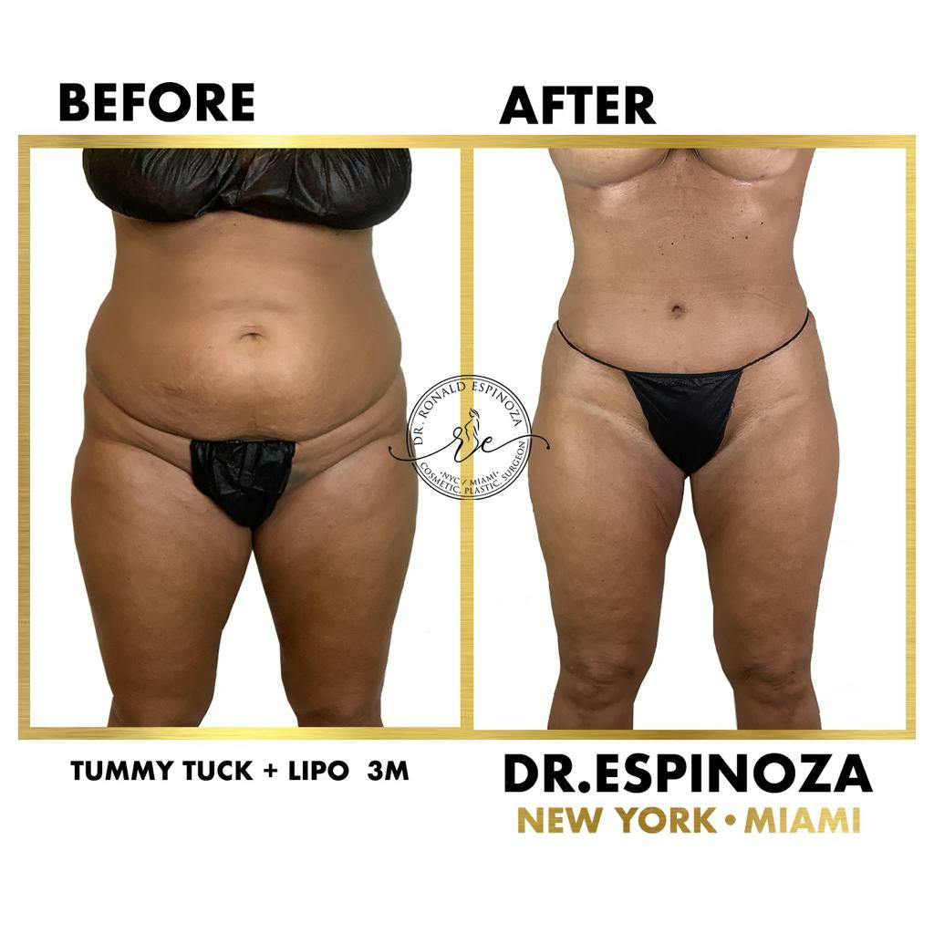 Tummy Tuck Before & After Gallery - Patient 119147147 - Image 1