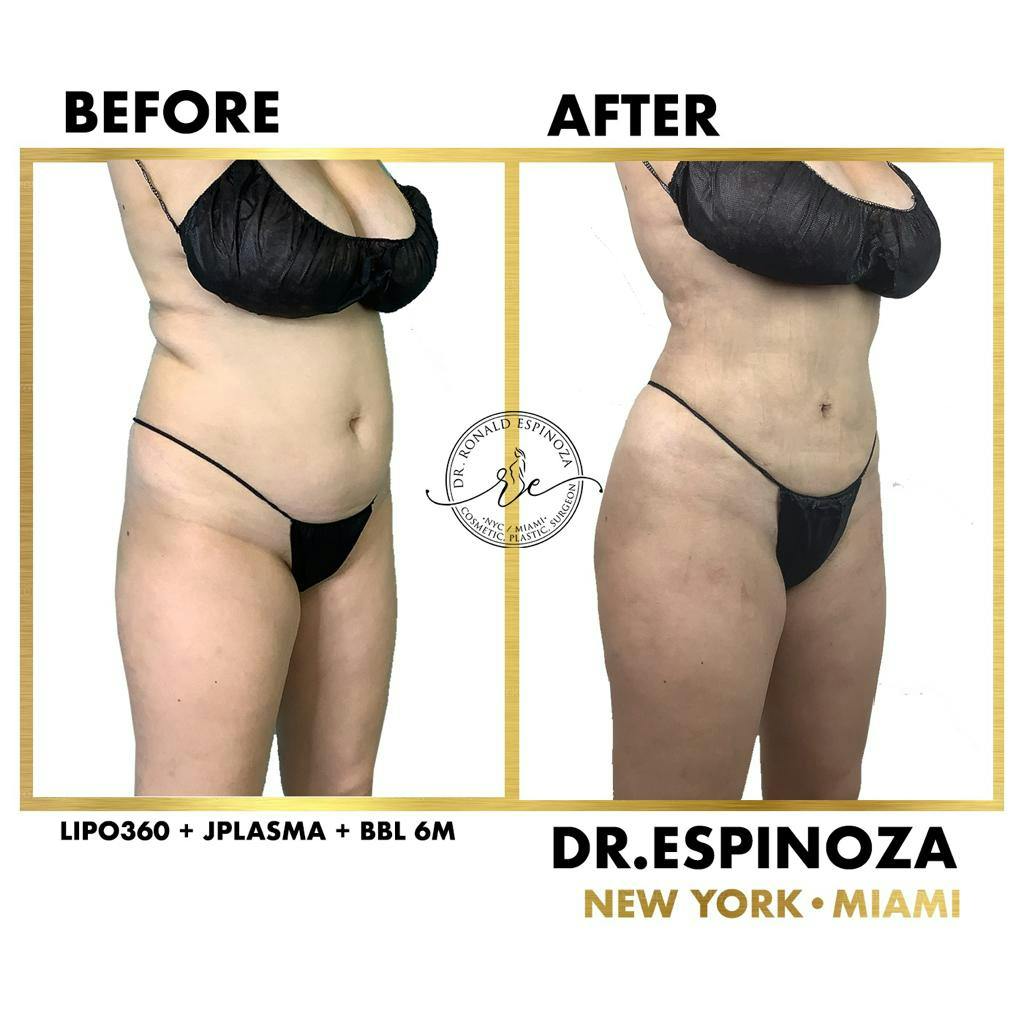 Tummy Tuck Before & After Gallery - Patient 119147148 - Image 1