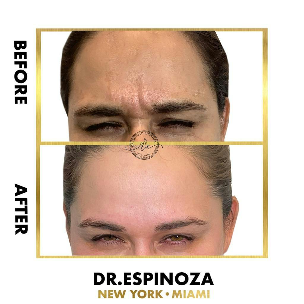 Before & After BOTOX By Dr. Espinoza