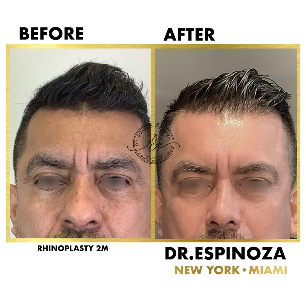 Rhinoplasty Before & After Gallery - Patient 119147160 - Image 1