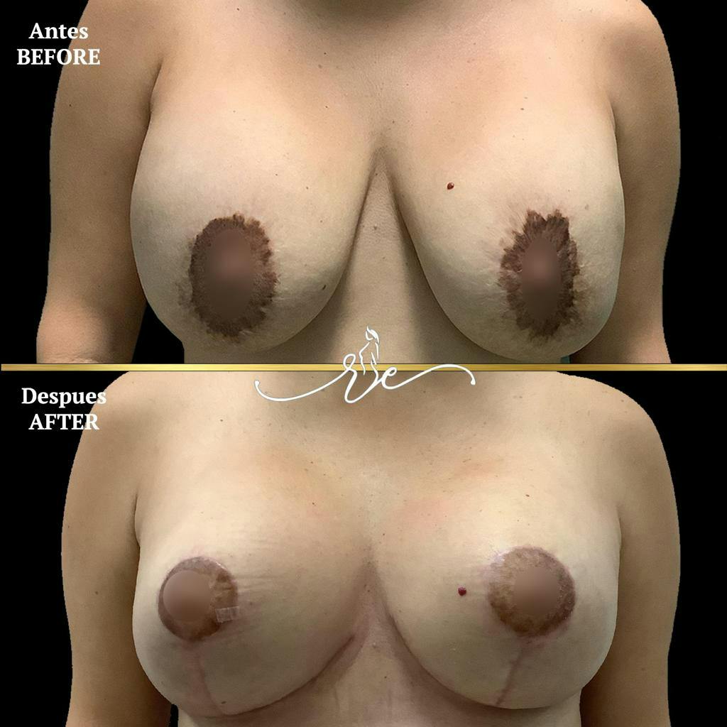 Breast Lift Before & After Gallery - Patient 119147163 - Image 1