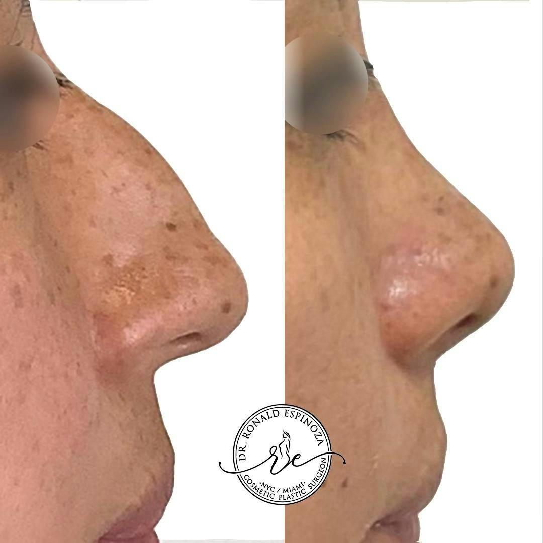 Rhinoplasty Before & After Gallery - Patient 142705684 - Image 1