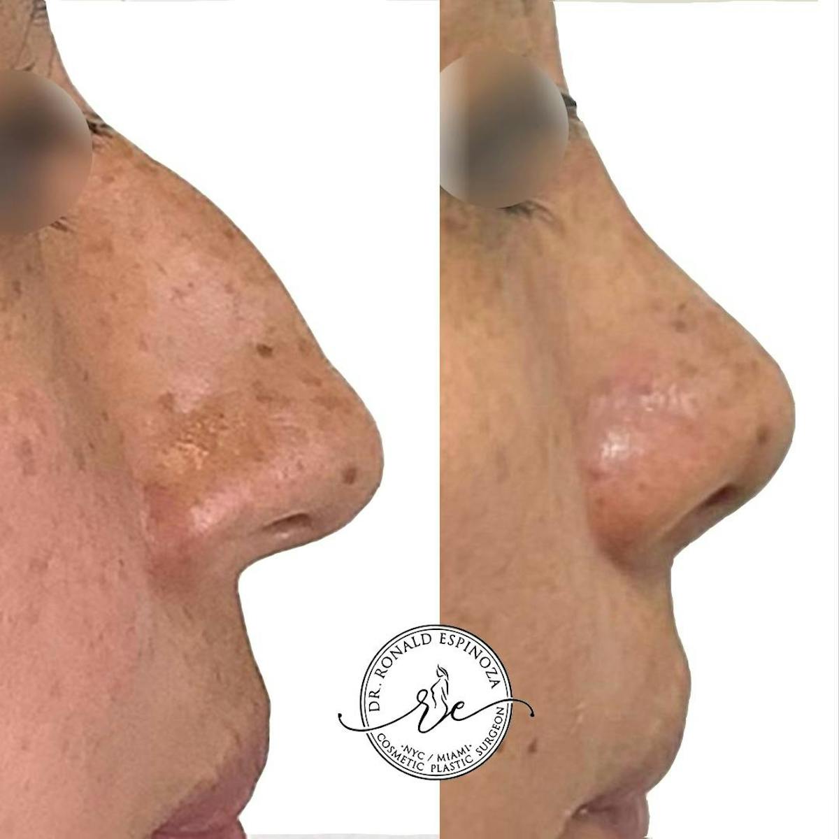 Rhinoplasty Before & After Gallery - Patient 142705684 - Image 1