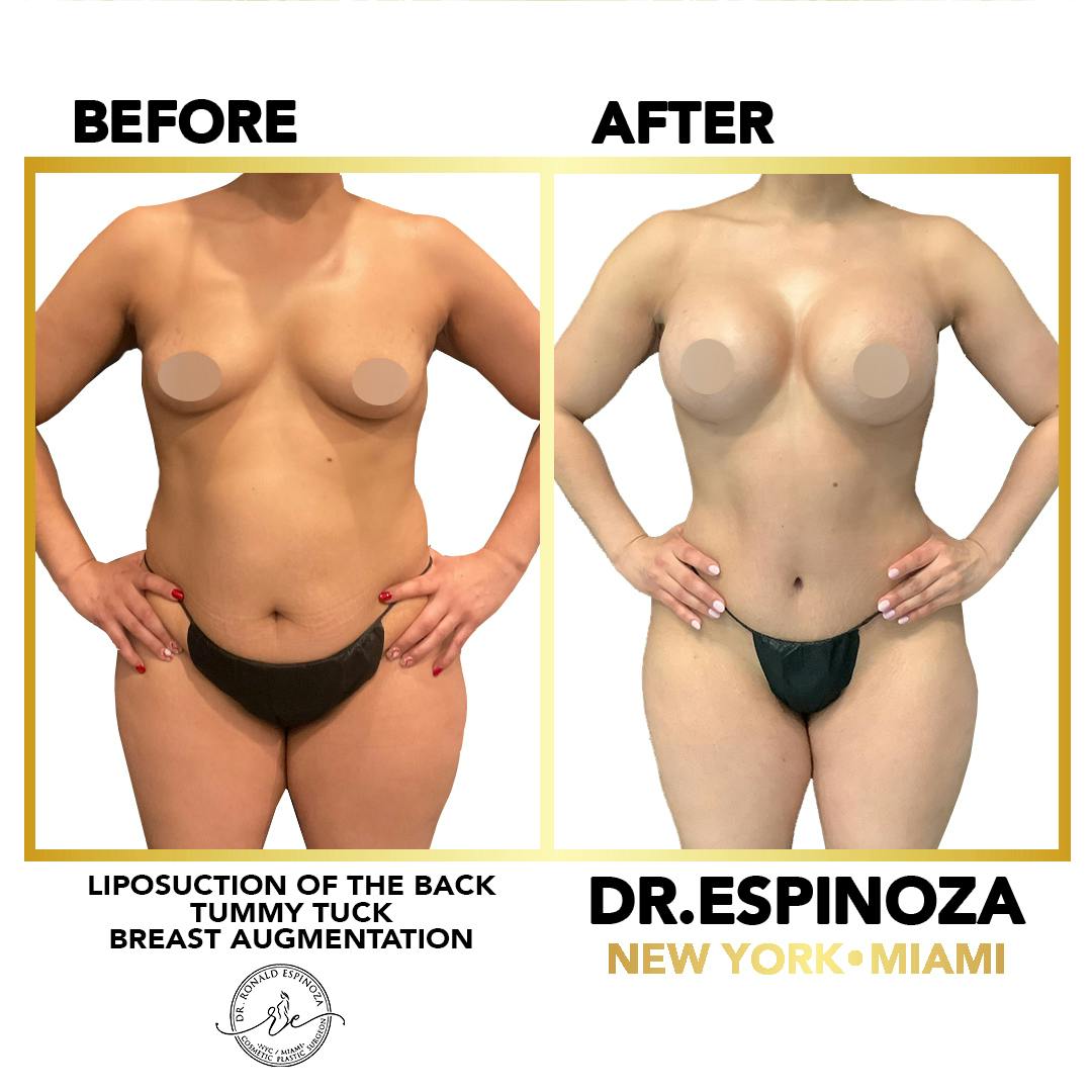 Mommy Makeover Before & After Gallery - Patient 148257394 - Image 1