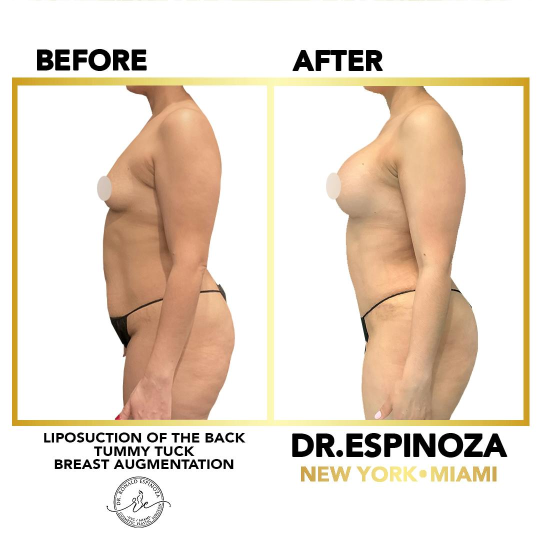 Mommy Makeover Before & After Gallery - Patient 148257394 - Image 2