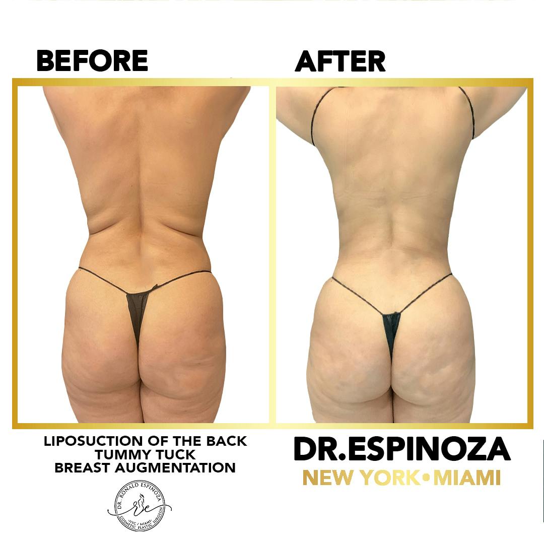 Mommy Makeover Before & After Gallery - Patient 148257394 - Image 3