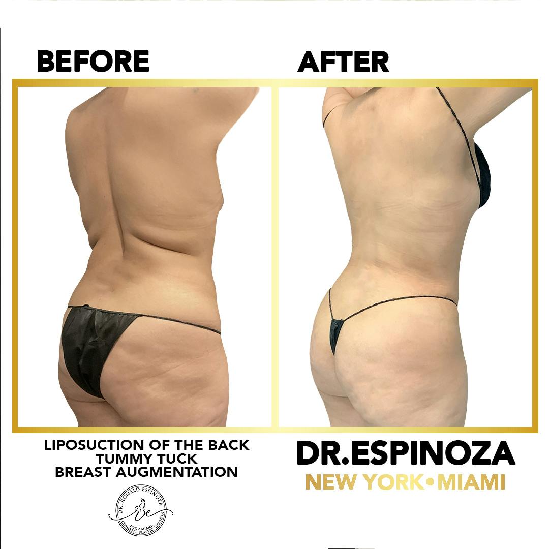 Mommy Makeover Before & After Gallery - Patient 148257394 - Image 4