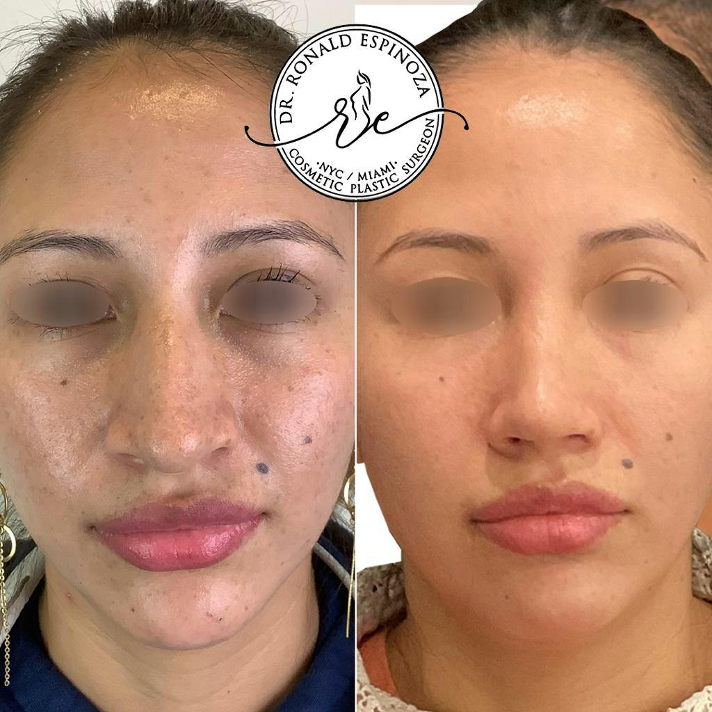 Rhinoplasty Before & After Gallery - Patient 150585036 - Image 2