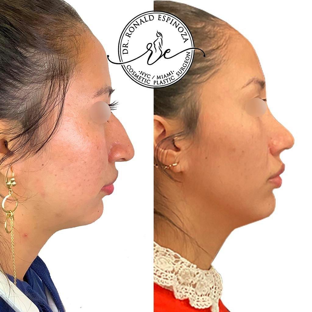 Rhinoplasty Before & After Gallery - Patient 150585036 - Image 1