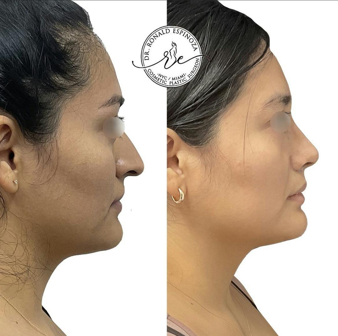 Rhinoplasty Before & After Gallery - Patient 150585038 - Image 1