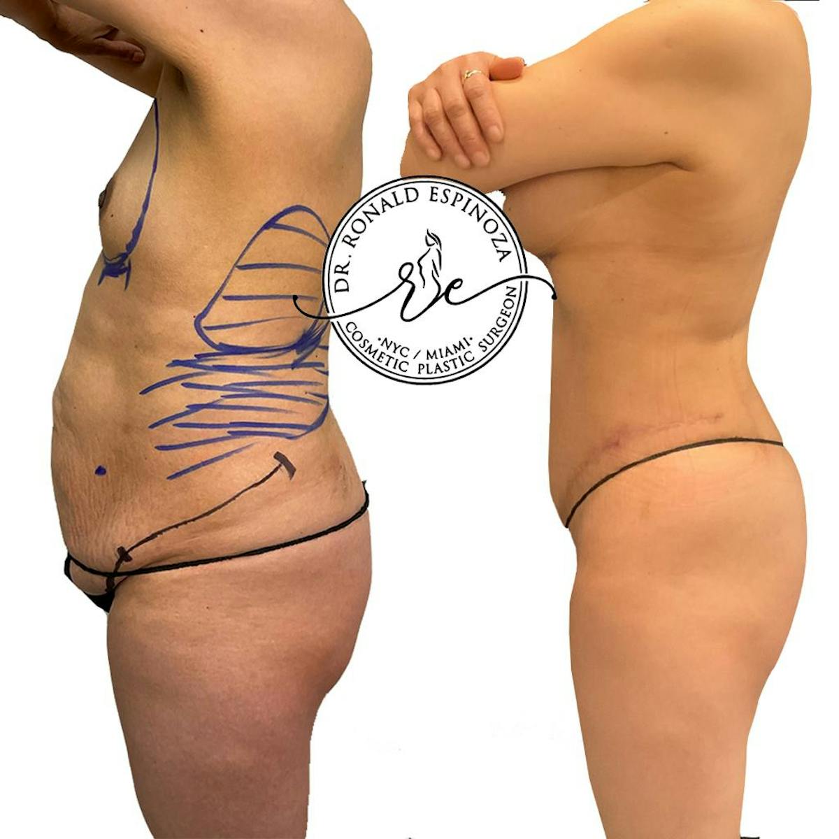 Tummy Tuck Before & After Gallery - Patient 154105325 - Image 3