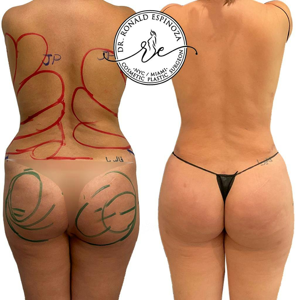 Liposuction Before & After Gallery - Patient 150585049 - Image 1