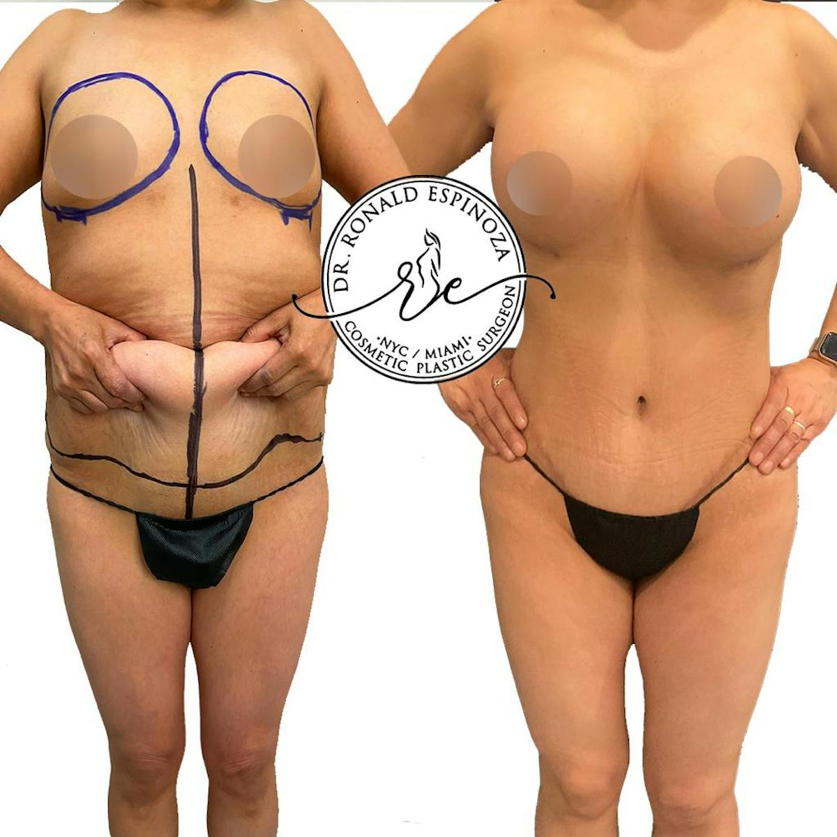 Tummy Tuck Before & After Gallery - Patient 154105325 - Image 1