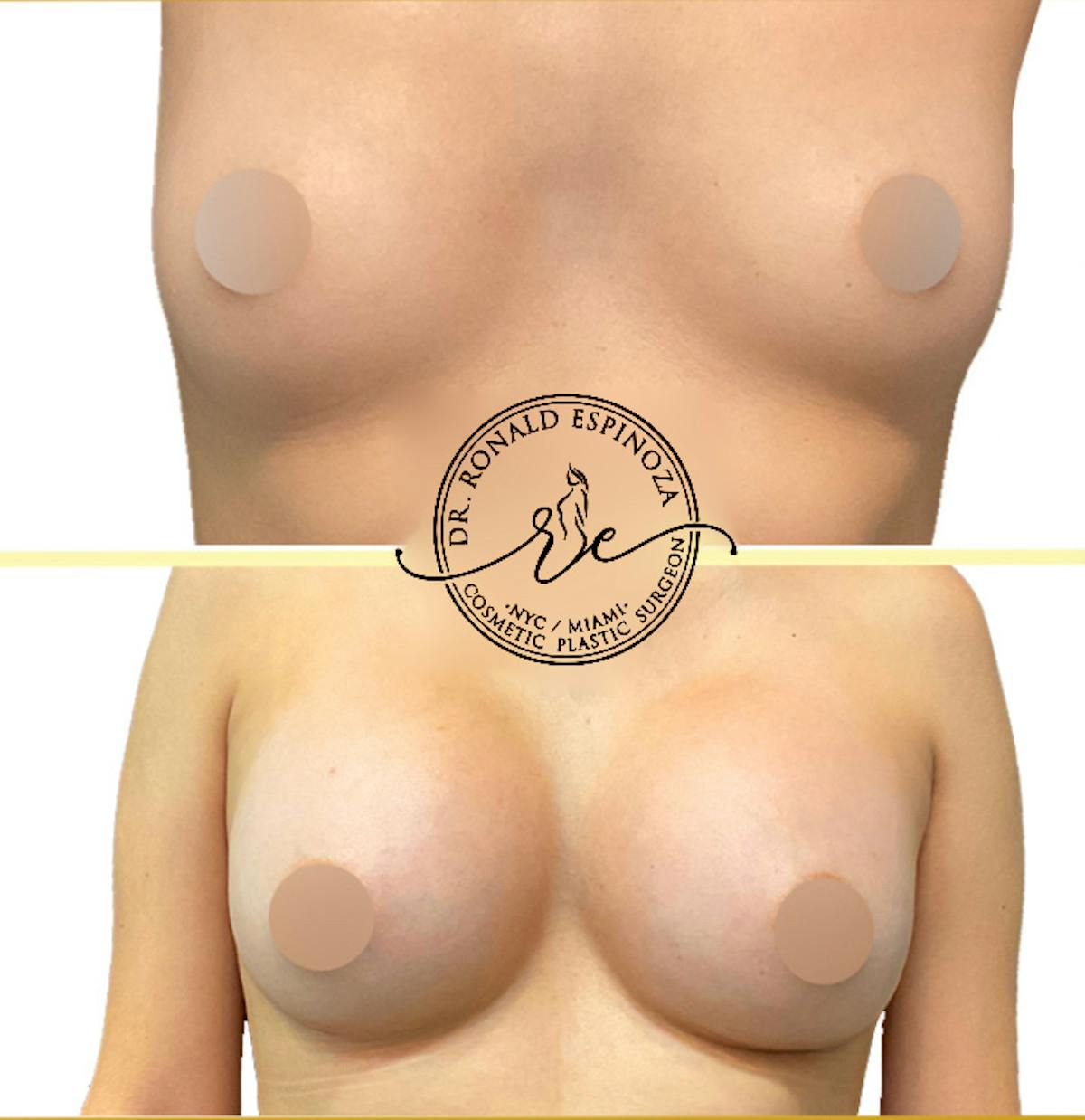 Breast Augmentation Before & After Gallery - Patient 160550823 - Image 1