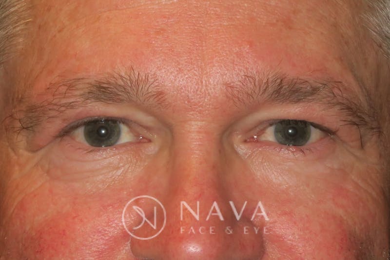 Browplasty Before & After Gallery - Patient 143347568 - Image 2
