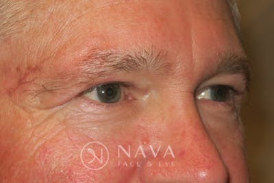 Upper Blepharoplasty (Upper Eyelid Surgery) Before & After Gallery - Patient 143347564 - Image 4