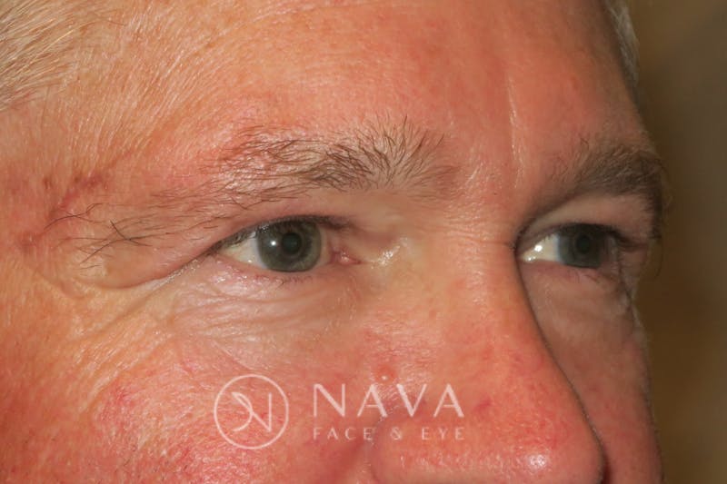 Browplasty (Brow Lift) Before & After Gallery - Patient 143347568 - Image 4
