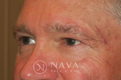 Upper Blepharoplasty (Upper Eyelid Surgery) Before & After Gallery - Patient 143347564 - Image 6