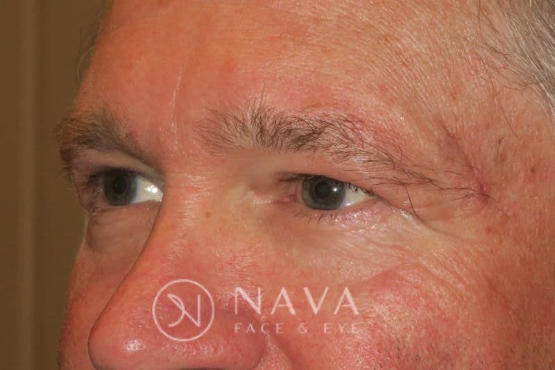 Browplasty (Brow Lift) Before & After Gallery - Patient 143347568 - Image 6