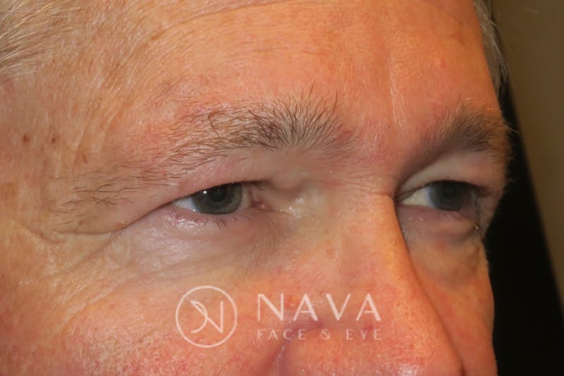 Browplasty (Brow Lift) Before & After Gallery - Patient 143347568 - Image 3