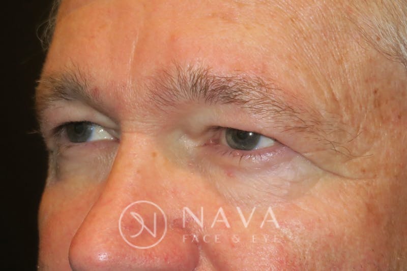 Upper Blepharoplasty (Upper Eyelid Surgery) Before & After Gallery - Patient 143347564 - Image 5