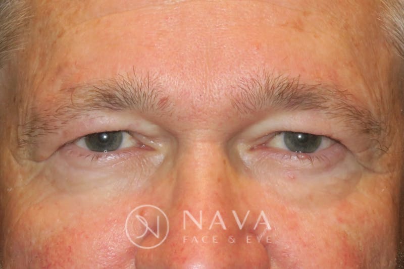 Upper Blepharoplasty Before & After Gallery - Patient 143347564 - Image 1