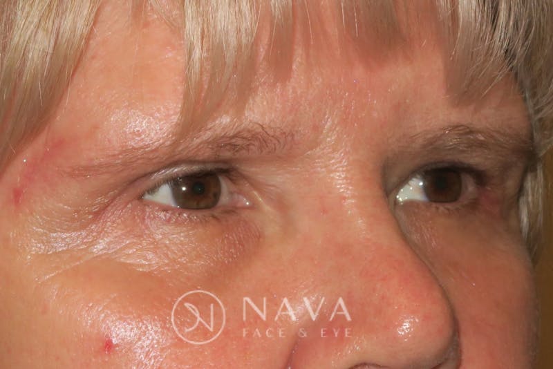 Browplasty Before & After Gallery - Patient 143347570 - Image 4