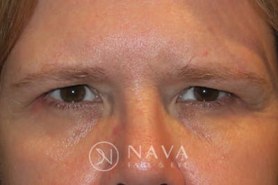 Upper Blepharoplasty (Upper Eyelid Surgery) Before & After Gallery - Patient 143347567 - Image 1