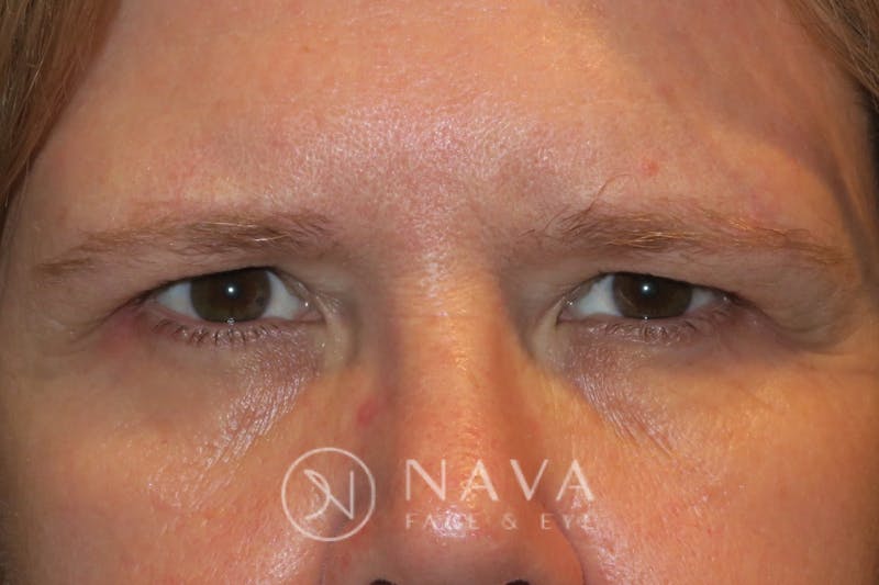 Browplasty (Brow Lift) Before & After Gallery - Patient 143347570 - Image 1