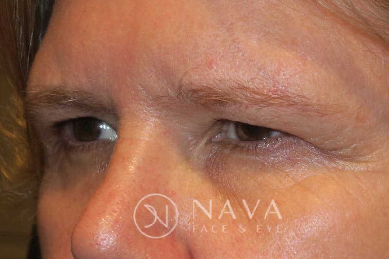 Browplasty (Brow Lift) Before & After Gallery - Patient 143347570 - Image 5