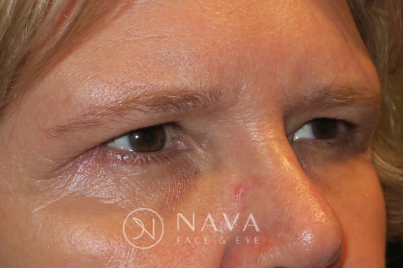 Browplasty (Brow Lift) Before & After Gallery - Patient 143347570 - Image 3