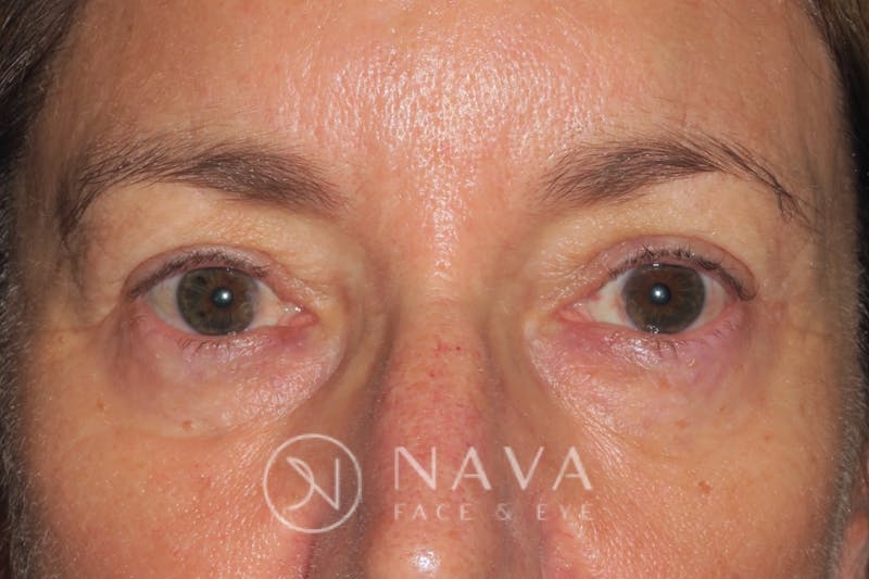Lower Blepharoplasty (Lower Eyelid Surgery) Before & After Gallery - Patient 143347571 - Image 1