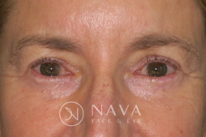 Lower Blepharoplasty (Lower Eyelid Surgery) Before & After Gallery - Patient 143347571 - Image 2