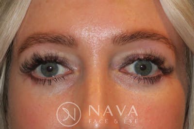Lower Blepharoplasty (Lower Eyelid Surgery) Before & After Gallery - Patient 143347574 - Image 2