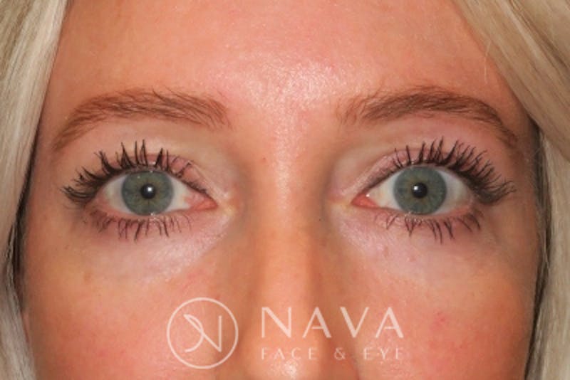 Lower Blepharoplasty (Lower Eyelid Surgery) Before & After Gallery - Patient 143347574 - Image 1