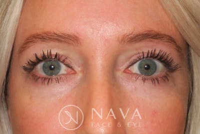 Lower Blepharoplasty (Lower Eyelid Surgery) Before & After Gallery - Patient 143347574 - Image 1