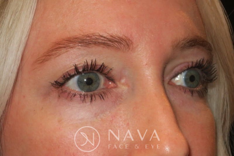 Lower Blepharoplasty Before & After Gallery - Patient 143347574 - Image 3