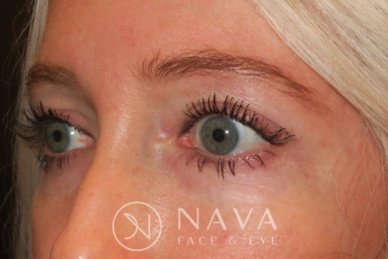 Lower Blepharoplasty (Lower Eyelid Surgery) Before & After Gallery - Patient 143347574 - Image 5